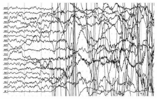 Что такое эпилепсия