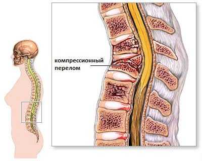 Симптомы и лечение компрессионного перелома в Санкт-Петербурге