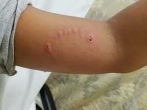 Симптомы укуса