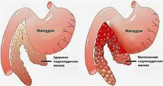 Заболевания желудочно-кишечного тракта